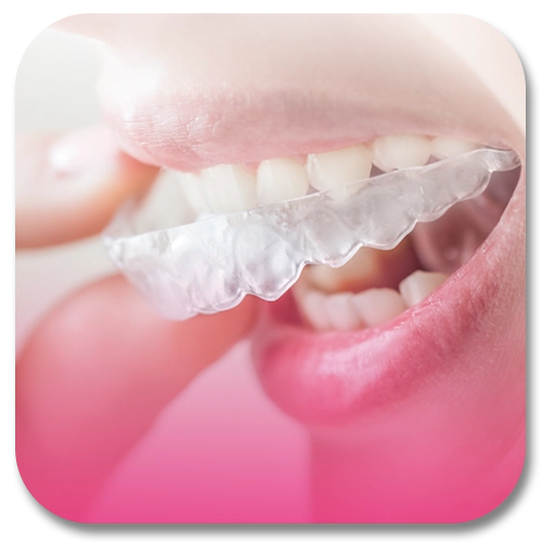 dental aligners