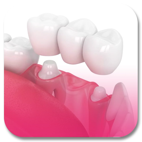 dental crown and bridge