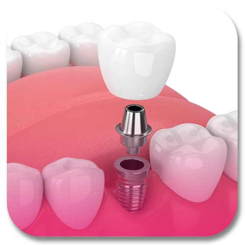 dental implant