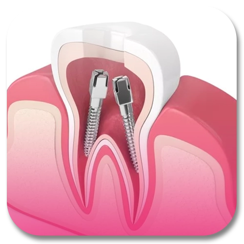 dental pin