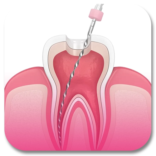 dental root canal treatment