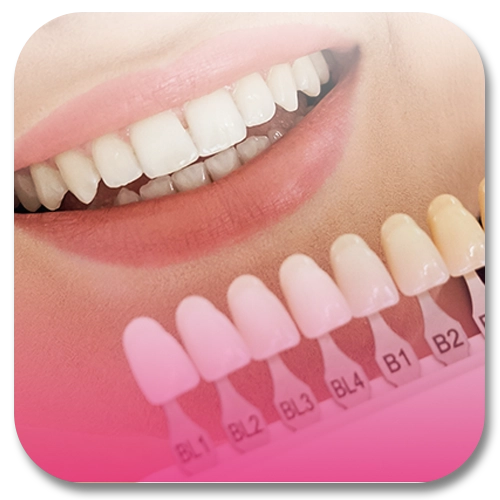 dental veneers