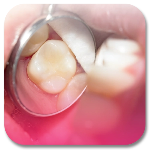 dental white filling
