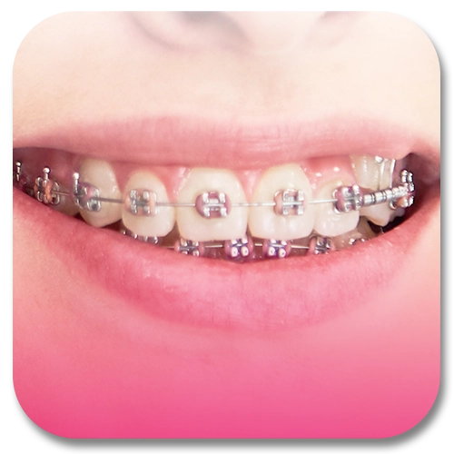 orthodontic brace treatment
