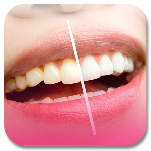 teeth whitening program